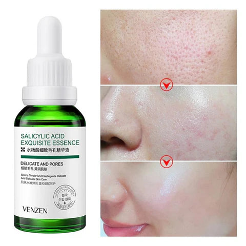Kit Antiacné Bioaqua con Ácido Salicílico